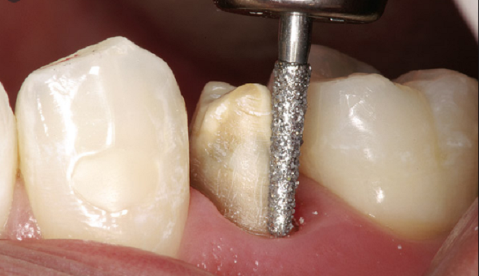 Quá trình mài cùi răng khi bọc 1 cái răng sứ