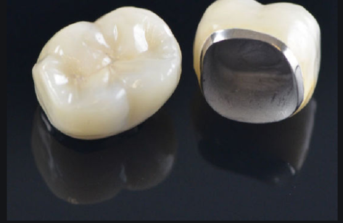Răng bọc sứ kim loại thường