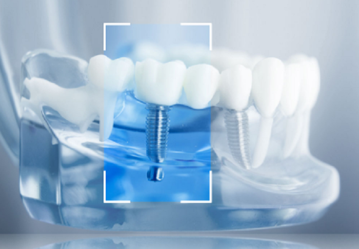 Trụ răng Implant tốt sẽ có khả năng tích hợp xương hàm cao