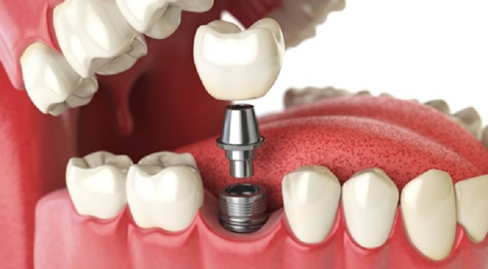 Trụ răng Implant tốt nhất hiện nay