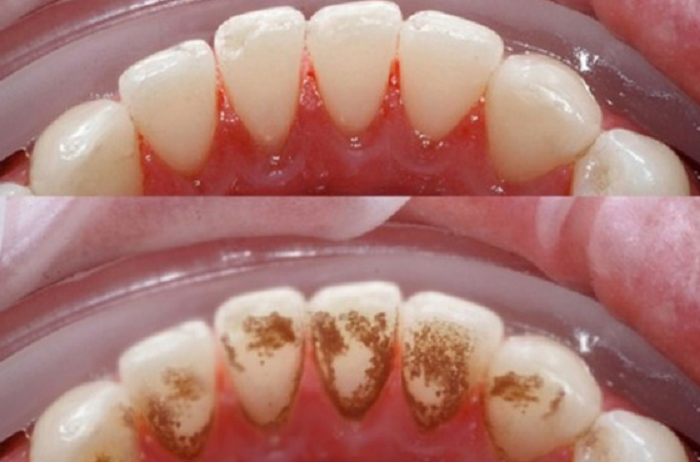 Sự khác biệt sau khi lấy cao răng