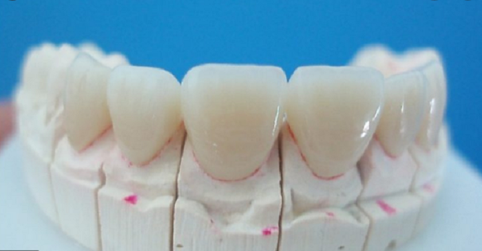 Răng sứ Ceramill có nhiều ưu điểm