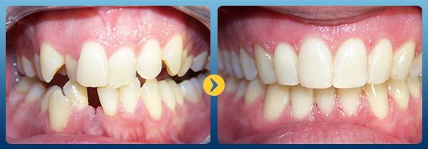 Trước và sau khi niềng răng tại nha khoa Quốc Tế Nacera Thi Sách