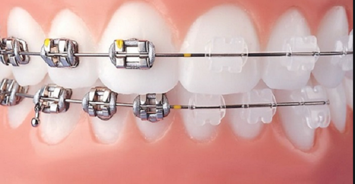 Niềng răng giúp bạn có hàm răng đều đẹp