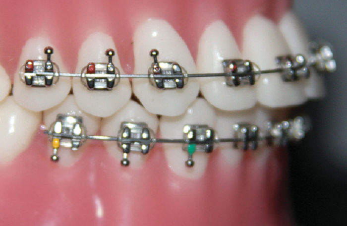 Niềng răng mắc cài kim loại gồm 5 bước