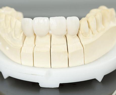 răng sứ Katana Nhật Bản bạn sẽ được bảo hành lên đến 15 năm