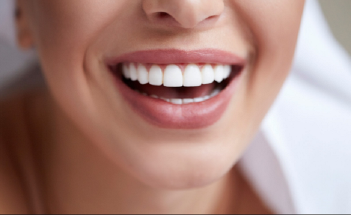 Quy trình trồng răng sứ thường mất 2 - 4 ngày 