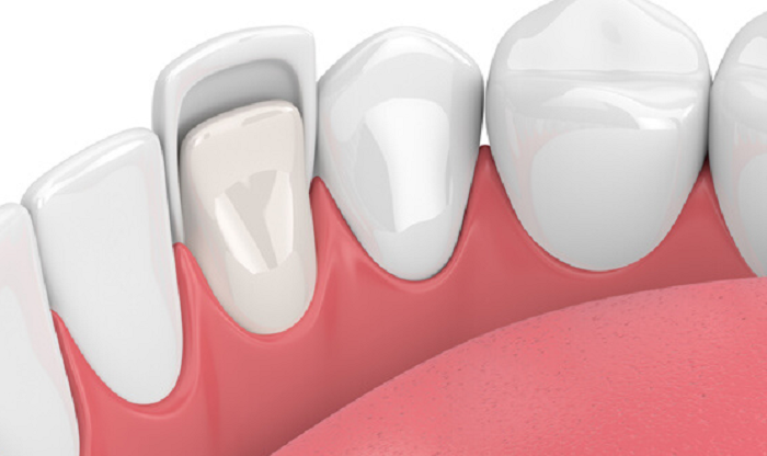 Veneer sứ HT giúp phục hình răng hiệu quả