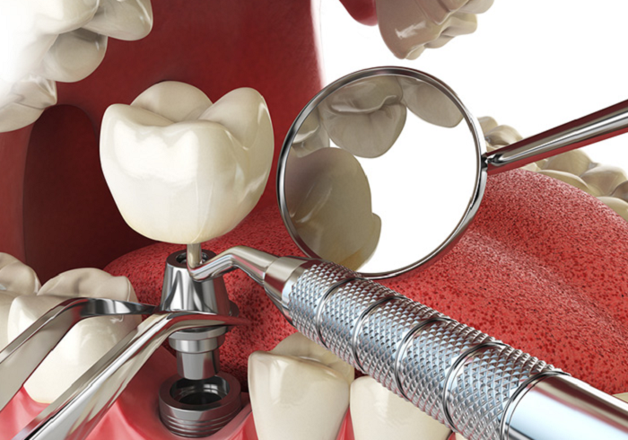 Phương pháp trồng răng số 7 bằng phương pháp cấy ghép Implant