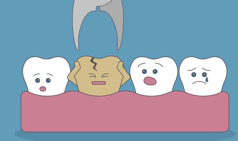 Quy trình nhổ răng số 7 gồm 5 bước