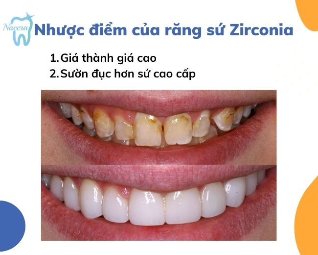 Nhược điểm của răng sứ Zirconia
