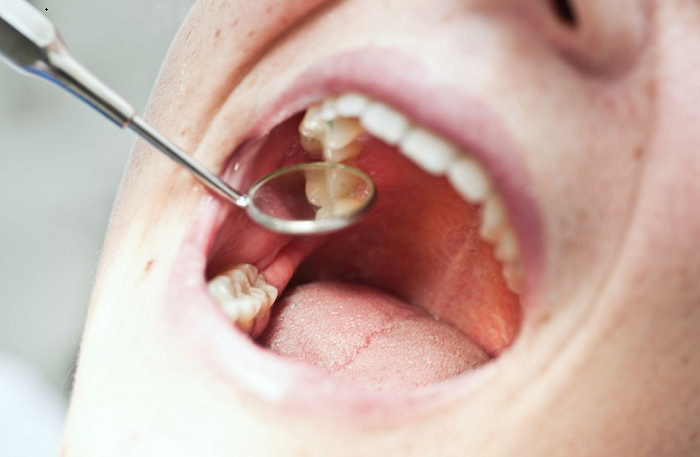 Quy trình nhổ răng số 8 và cách chăm sóc sau khi nhổ răng số 8 - Nha khoa  Nacerathisach.vn