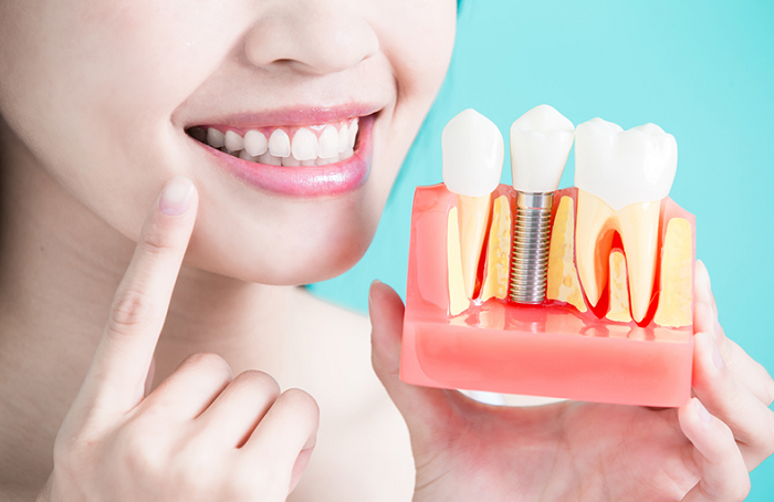 Răng số 7 ảnh hưởng đến các răng xung quanh, do vậy bạn nên trồng răng số 7