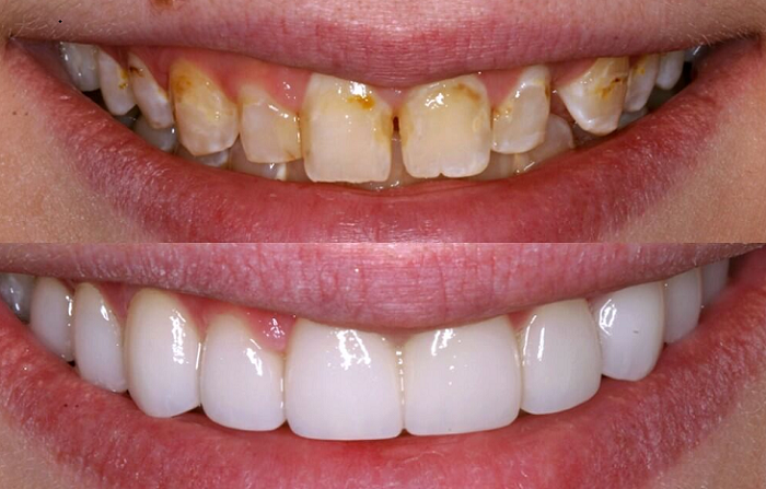 Sự thay đổi sau khi làm răng sứ Zirconia