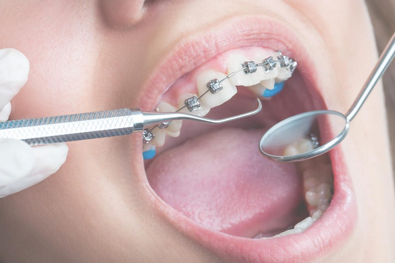 Với niềng răng mắc cài kim loại tự buộc thì bạn sẽ ít phải đến nha khoa hơn