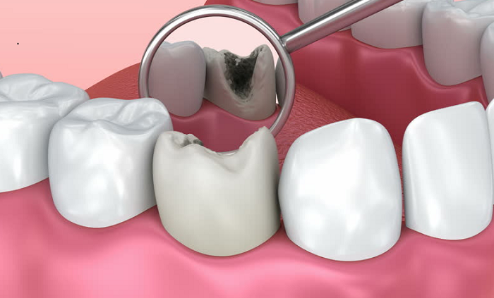 Sâu răng nhẹ không nên nhổ răng số 6 mà nên hàn trám răng