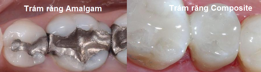 Trám răng Composite có tính thẩm mỹ cao hơn Amalgam
