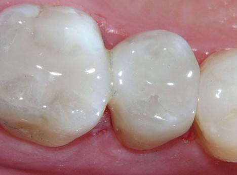 Trám răng Composite có màu sắc giống răng thật nên mang tính thẩm mỹ cao cho hàm răng