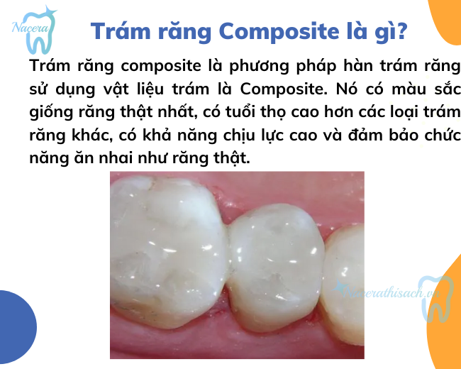 Trám răng Composite là gì?