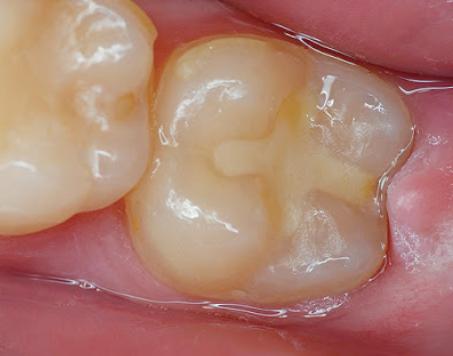 Trám răng Xi - Măng Silicat có tính thẩm mỹ cao nhưng không bằng Composite