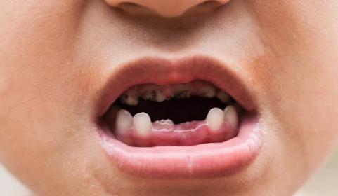 Răng bé bị đen có thể là triệu chứng của sâu răng