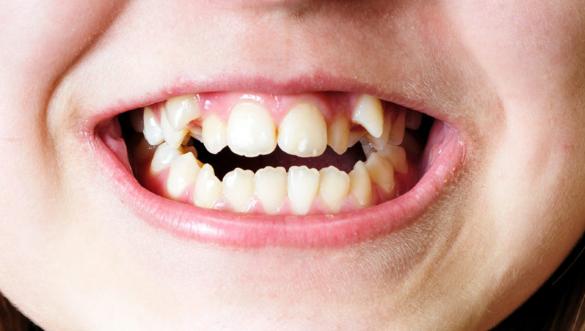 Răng vĩnh viễn mọc lệch vào trong có thể niềng răng chứ chưa phải nhổ