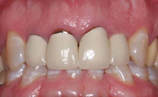 Bọc răng sứ giá rẻ có thể làm đen viền răng