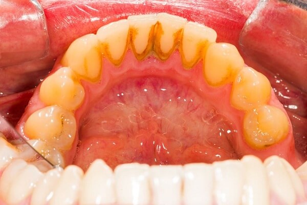 Cạo vôi răng quá nhiều sẽ gây viêm nướu, lâu ngày dẫn đến bệnh nha chu