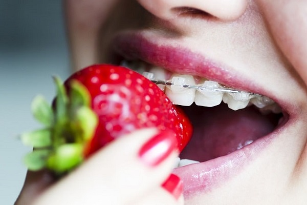 Lên kế hoạch ăn uống khoa học trong quá trình niềng răng