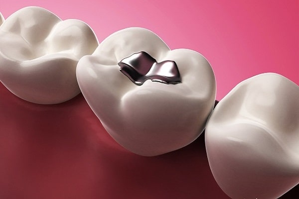 Khi răng xuất hiện các lỗ sâu thì bạn nên tiến hành trám răng sâu