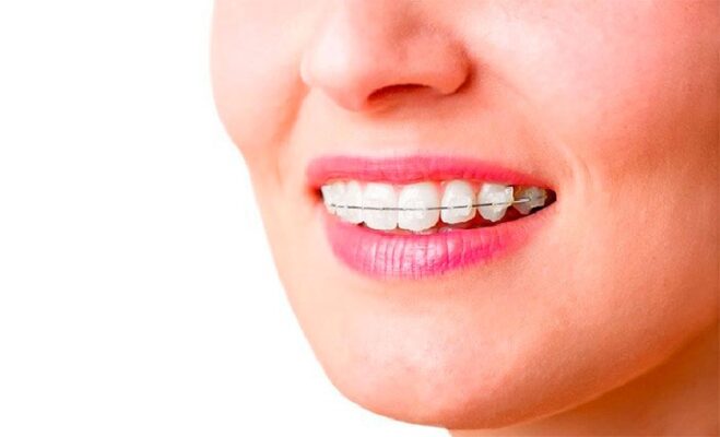 Niềng răng khắc phục tình trạng răng mọc sai biệt giúp bạn có nụ cười đẹp hơn