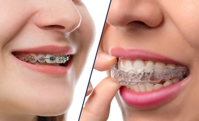 Niềng răng invisalign có nhiều ưu điểm nổi bật so với phương pháp niềng răng bằng mắc cài truyền thống
