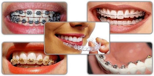 Có nhiều phương pháp niềng răng cho bệnh nhân lựa chọn