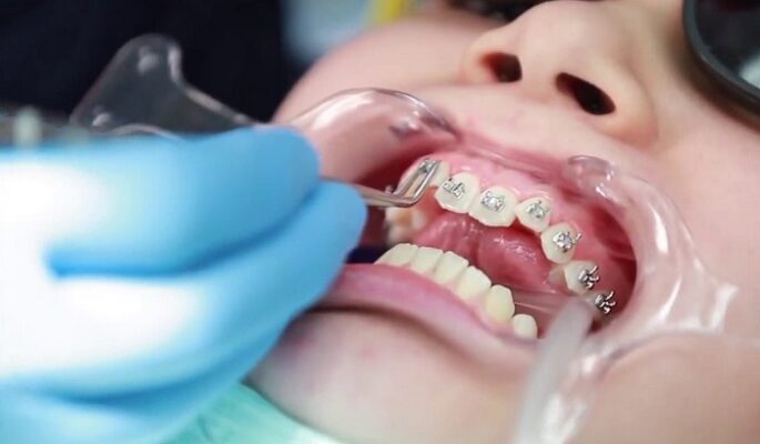 Niềng răng mắc cài sẽ không gây nguy hiểm nếu bạn lựa chọn nha khoa uy tín
