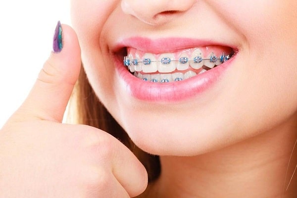 Niềng răng giúp cải thiện tình trạng răng quặp
