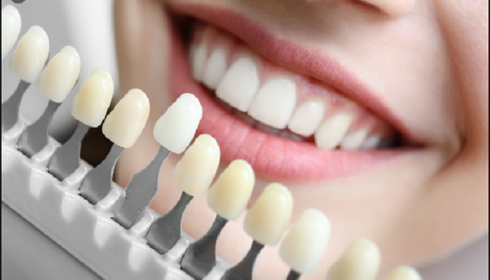 Quy trình trồng răng sứ gồm có 7 bước