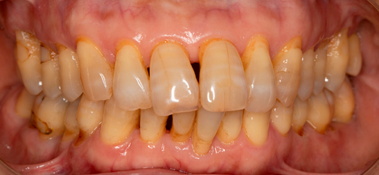 Các mảng bám lâu ngày trên răng gây ra bệnh viêm nha chu