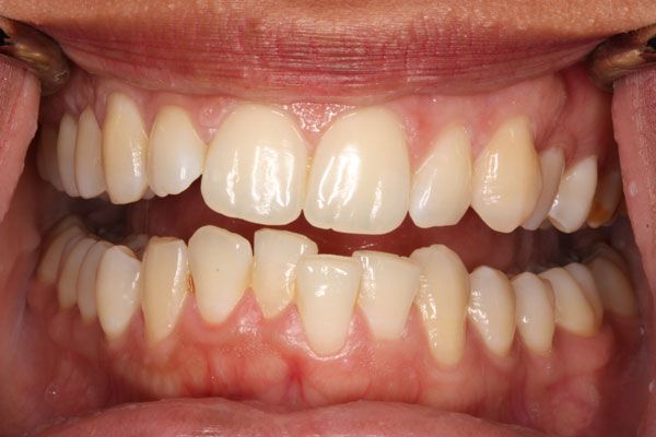 Răng khấp khểnh là tình trạng phổ biến hiện nay