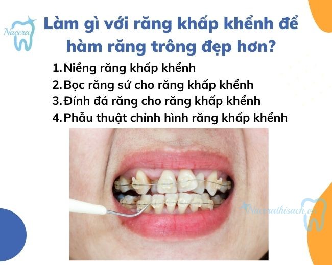 Làm gì với răng khấp khểnh để hàm răng trông đẹp hơn?
