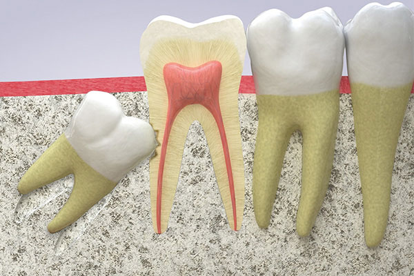 Răng khôn mọc lệch có thể làm hỏng răng số 7 bên cạnh