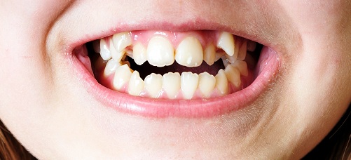 Răng mọc lộn xộn ảnh hưởng đến sức khỏe và thẩm mỹ