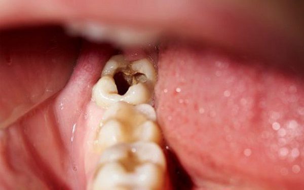 Sâu răng số 8 gây ra nhiều biến chứng nguy hiểm