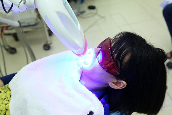 Tẩy trắng răng Laser Whitening là sự kết hợp giữa thuốc tẩy trắng và tia Laser