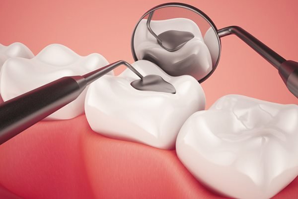 Phương pháp trám răng làm giảm khoảng hở cửa răng
