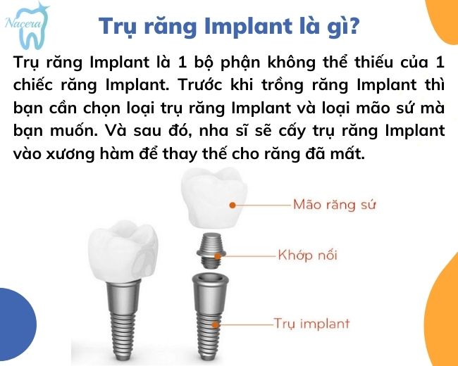 Trụ răng Implant là gì?