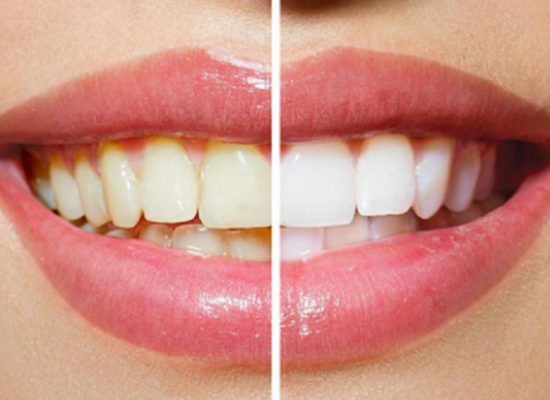 Sự khác biệt trước và sau khi tẩy trắng răng