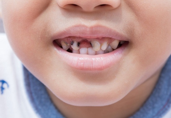 Trẻ em sâu răng có nên hàn răng hay không?